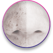 טיפול באקנה