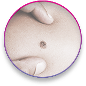 הסרת נקודות חן