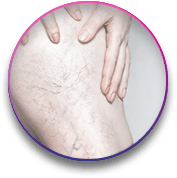 העלמת נימנים בלייזר