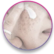 תמונה מעוצבת של טיפול להסרת נגעי עור בפנים – Medical C