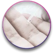 תמונה של טיפול להסרת יבלות בלייזר בקליניקת Medical C