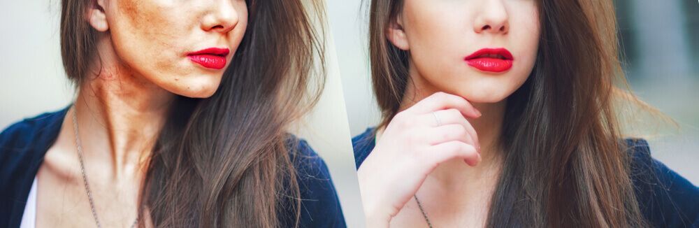 הסרת כתמי פיגמנטציה בפנים