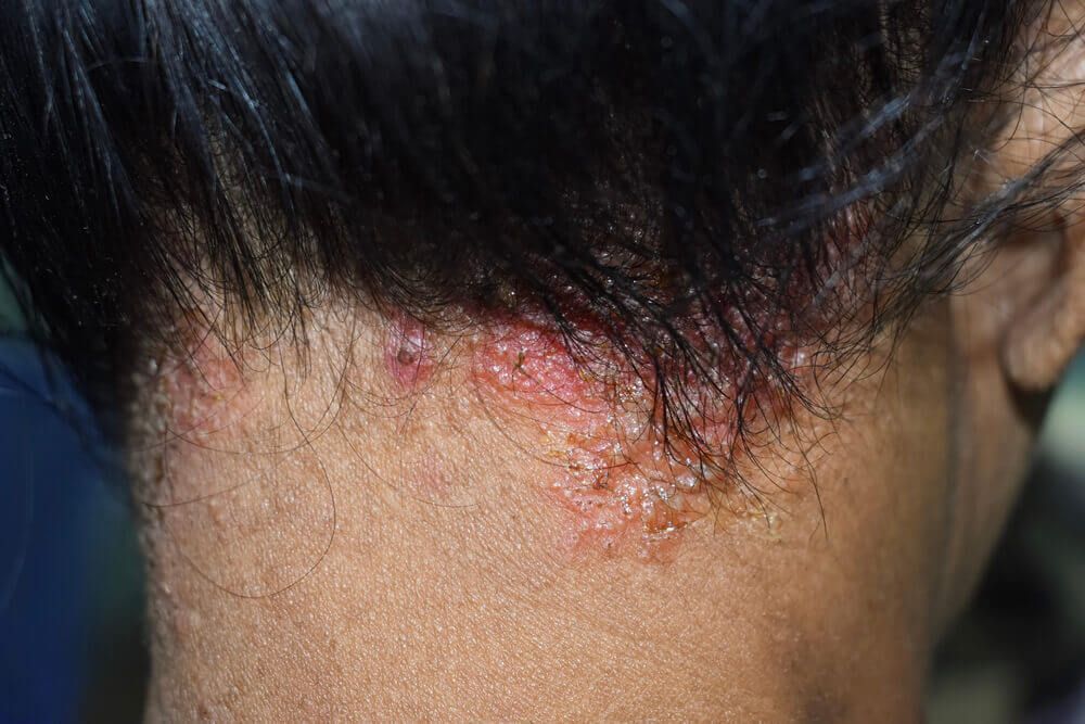 Seborrhoeic dermatitis