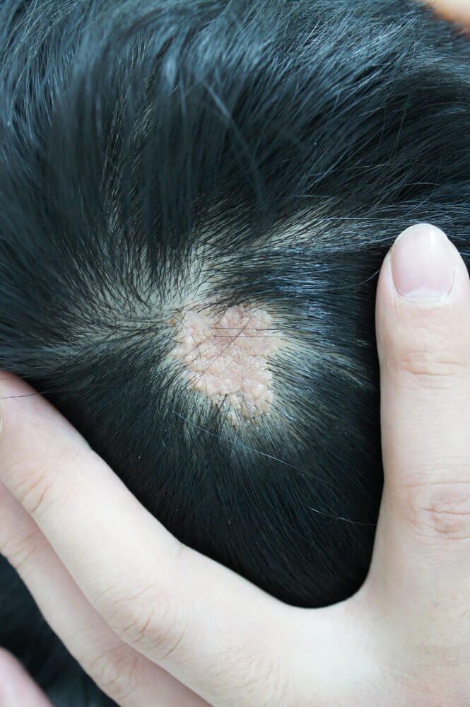 Hyperplasia Sebaceous