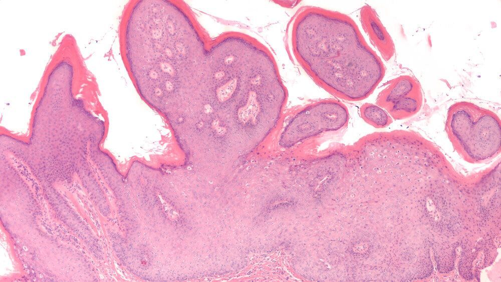 תמונת מיקרוסקופיה של קונדילומה הנגרמת מנגיף הפפילומה האנושי HPV