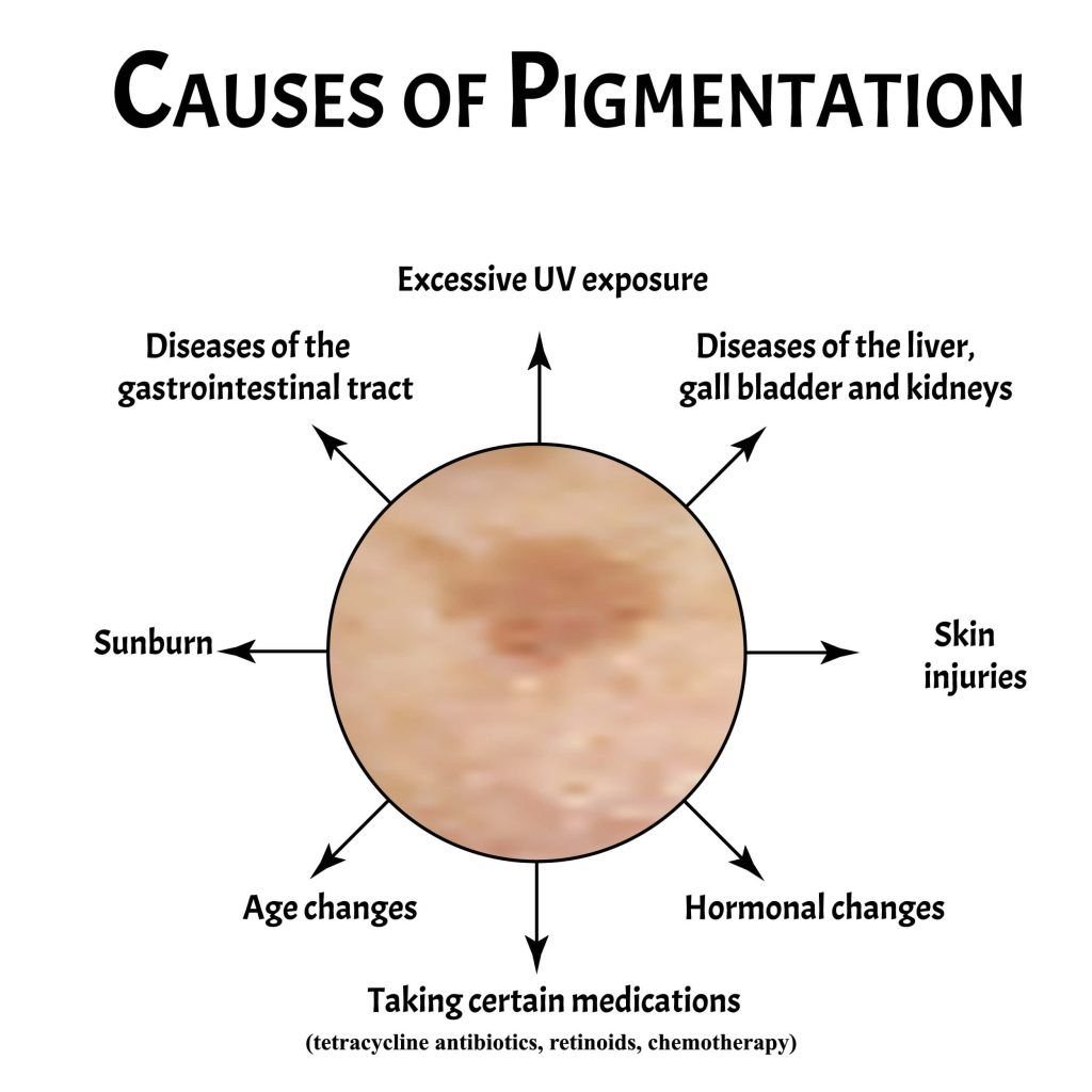 הסיבות לפיגמנטציה בפנים