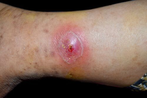 אבצס ברגל (מורסה/נגע דלקתי בעור) – הדגמה קלינית לפני טיפול/ניקוז והסרה ע״י רופא, ד״ר ג׳ורג׳ סאבא