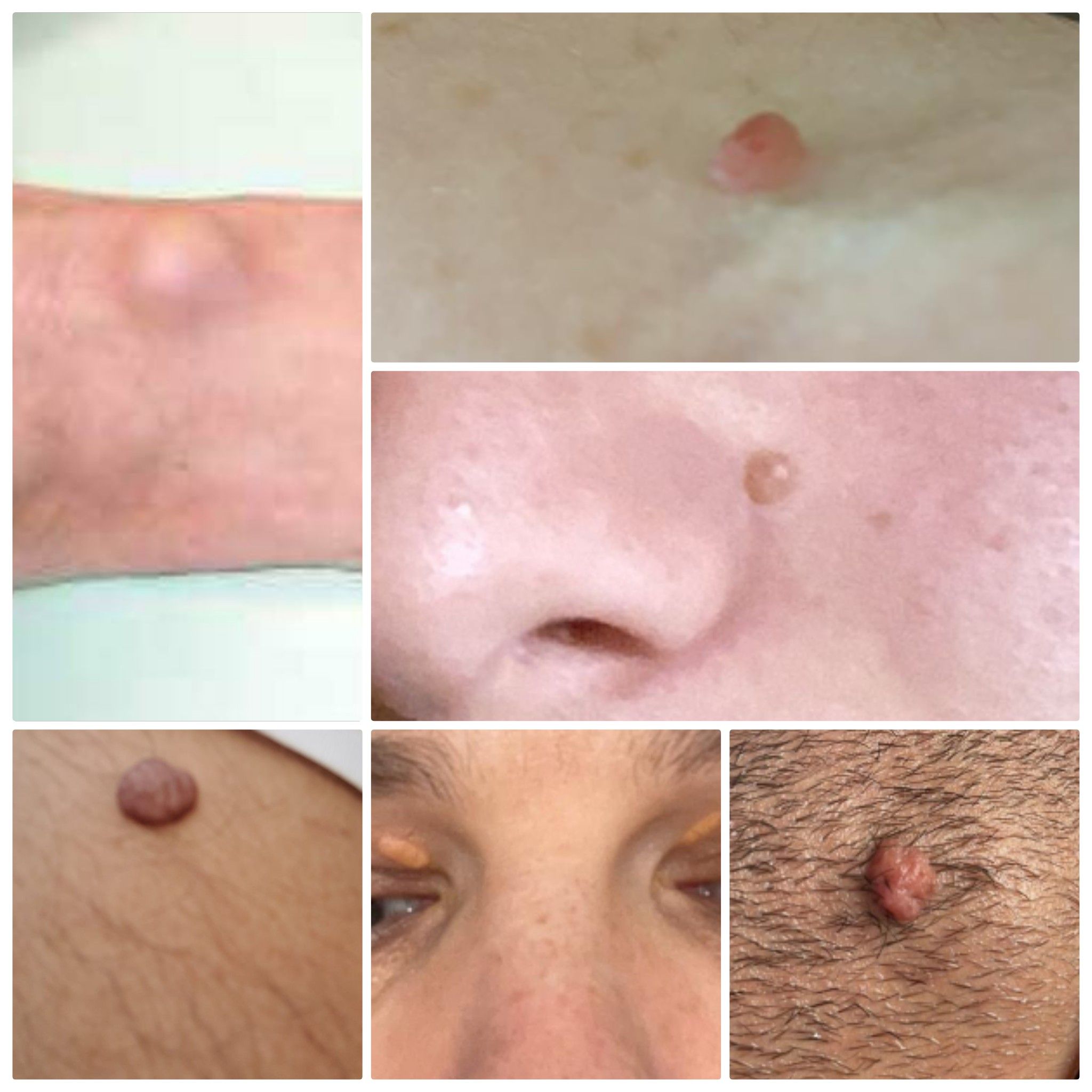 הסרת נגעי עור