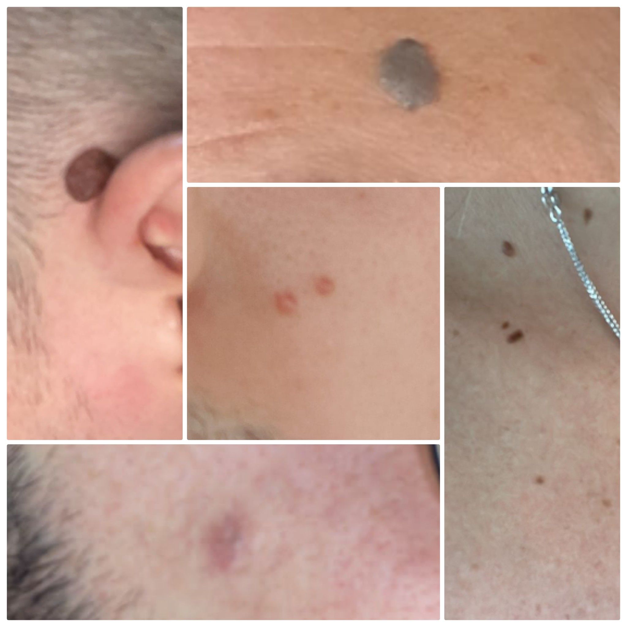 הסרת נגעי עור בנס ציונה