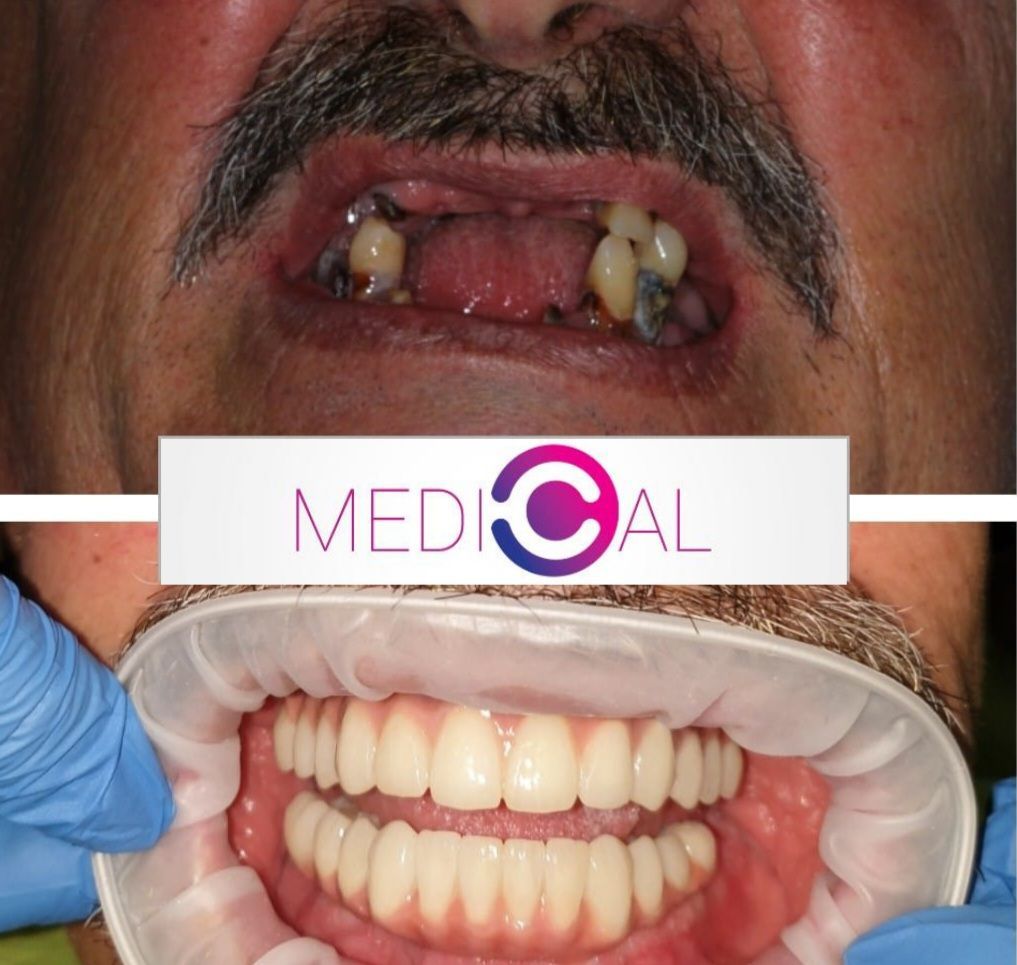 מחיר השתלת שיניים ברומניה