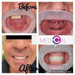 Implant dentar înainte și după