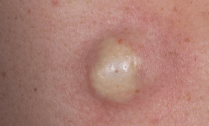 Îndepărtarea chistului