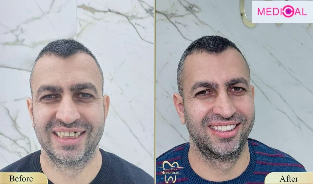 לפני ואחרי 2