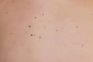 נקודות חן אדומות – המנגיומות בעור