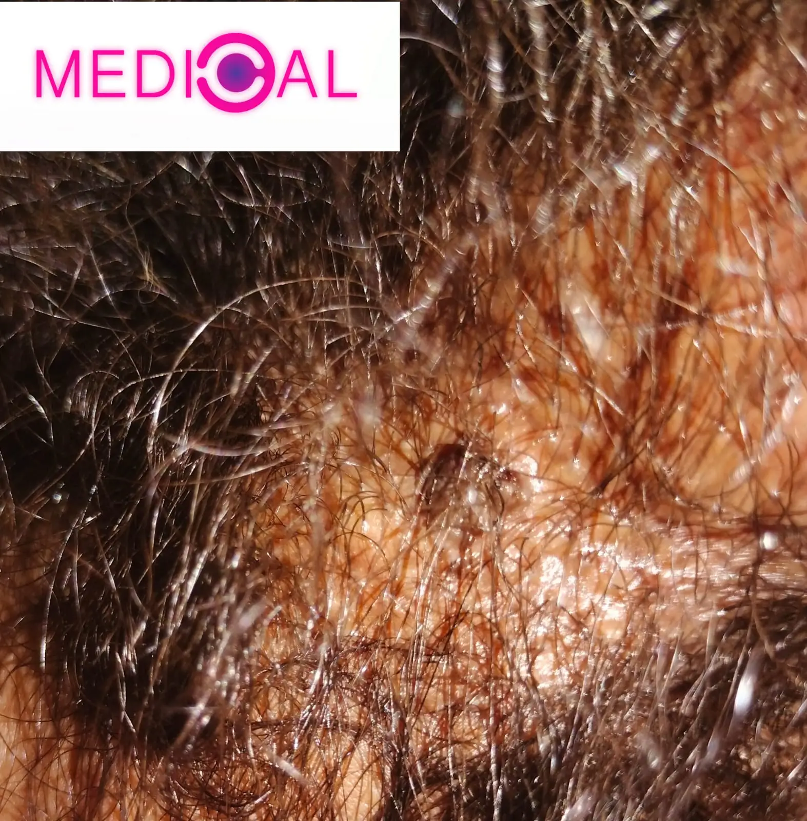 Condyloma-pictures-2-1-Ro