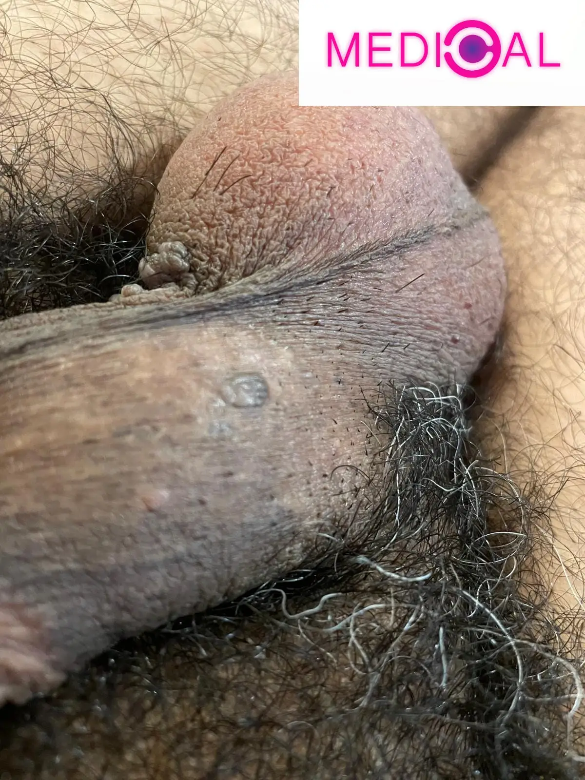 Condyloma-pictures-3-RO