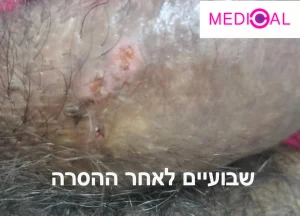 קונדילומה גברים