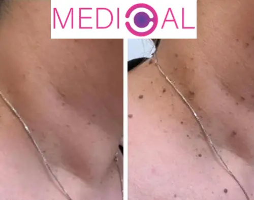 Prim-plan al gâtului – comparație „înainte și după” îndepărtarea negilor cutanați: în stânga se observă mai mulți negi cutanați, iar în dreapta aspectul este mai curat după tratament la clinica Medical-C.