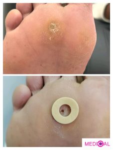 יבלת בכף הרגל / הסרת יבלות ברגליים