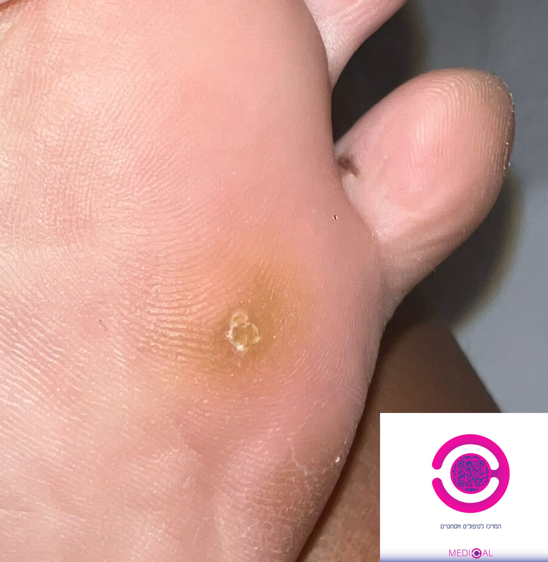 תקריב של יבלת מסמר (יבלת ויראלית) בכרית כף הרגל ליד הבוהן, עם מרכז שקוע והתקשות סביב