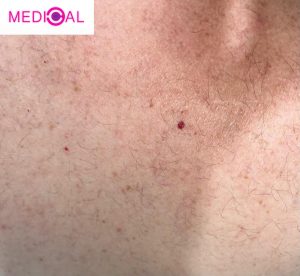 תקריב עור מבוגר עם המנגיומה (אנגיומת דובדבן) קטנה על הגו