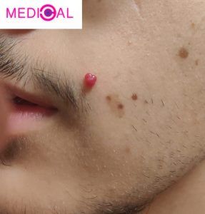 המנגיומה בעור