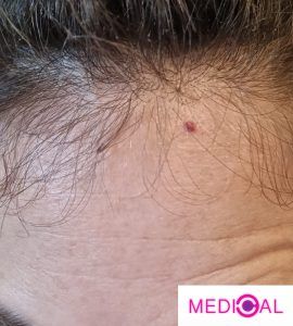 נק-אדומות-קטנות-על-העור