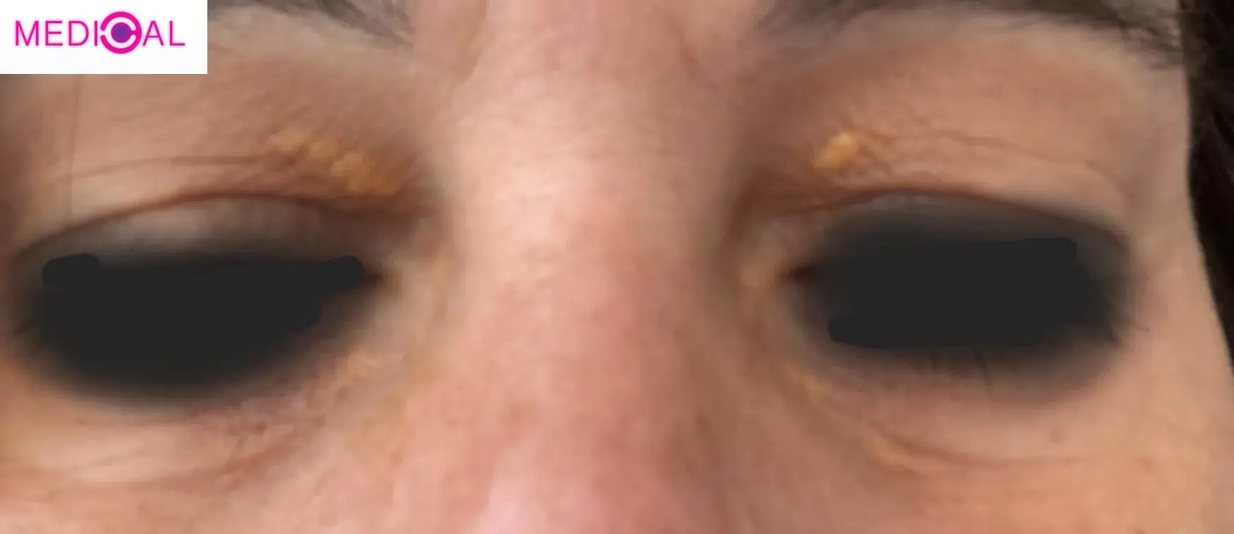 קסנטלזמה בעפעפיים – כתמים שומניים צהבהבים באזור העיניים