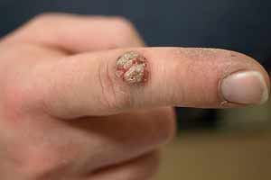 finger-wart