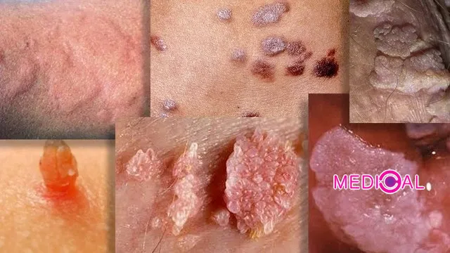 השוואה בין שיטות להסרת קונדילומה – טיפול בלייזר, חנקן נוזלי, פלזמה ומשחות