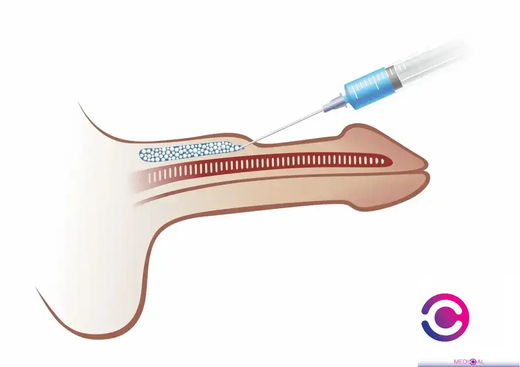 penis-enlargement-girth-filler-injection_medical-c-ro