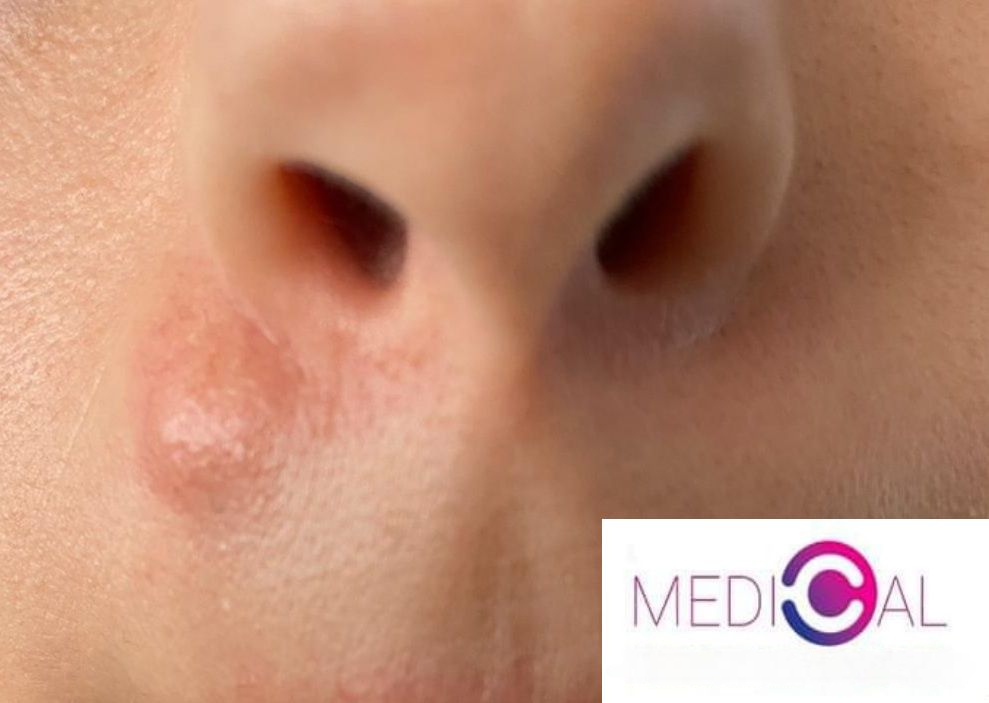 Îndepărtarea negilor