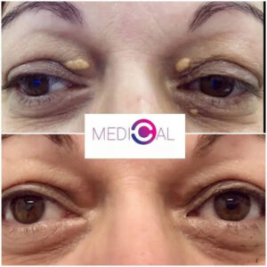 Fotografie înainte și după tratamentul cu laser pentru îndepărtarea xantelasmei pleoapelor – Medical C