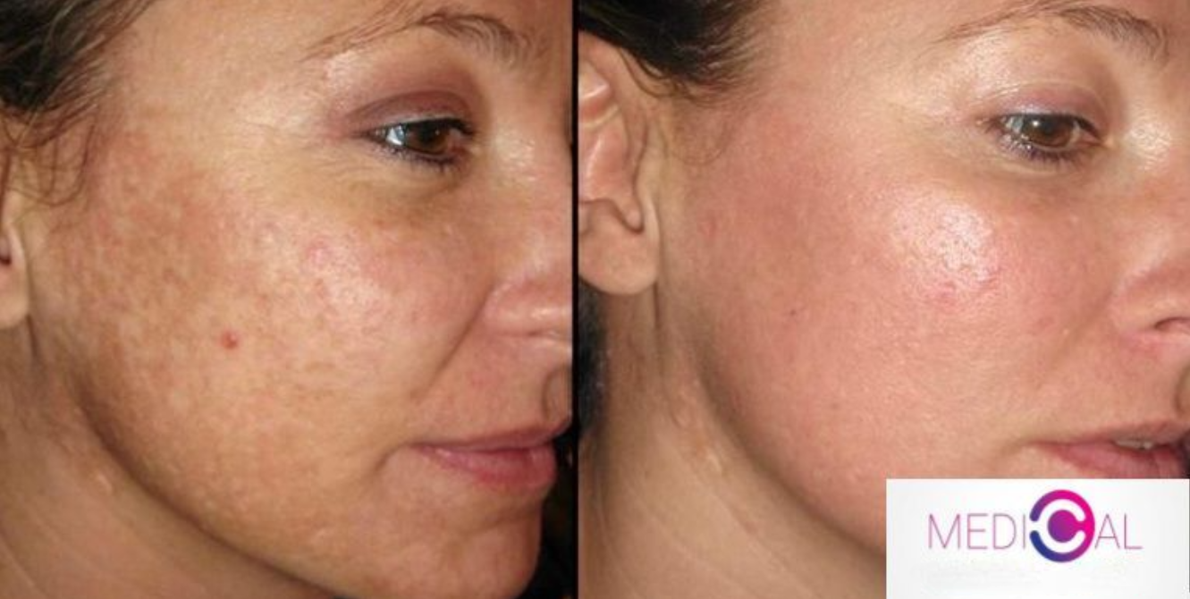 Cicatrici post-acnee