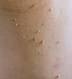 Mici excrescențe cutanate pe gât – un exemplu comun de leziuni benigne ale pielii înainte de îndepărtarea cu laser