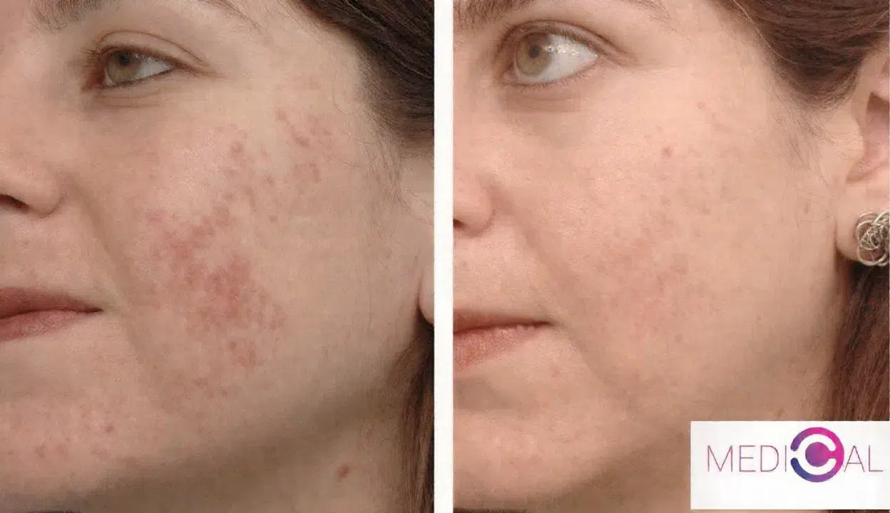 Tratament-cicatrici-faciale